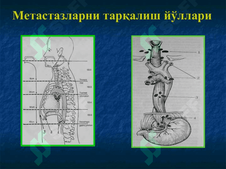 Қизилўнгач касалликлари. Кардиоспазм 7