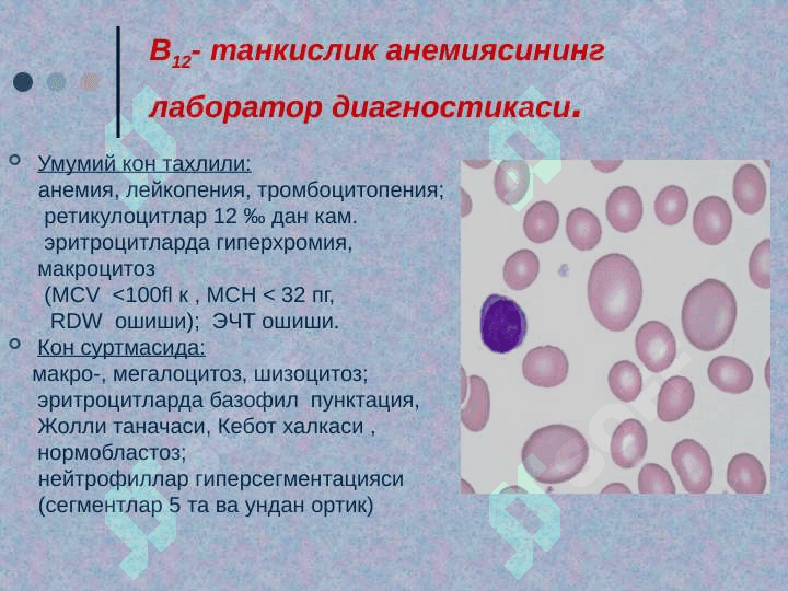 Мегалобласт анемиялар 8