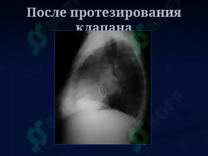 Лучевая диагностика заболеваний сердца и сосудов 8