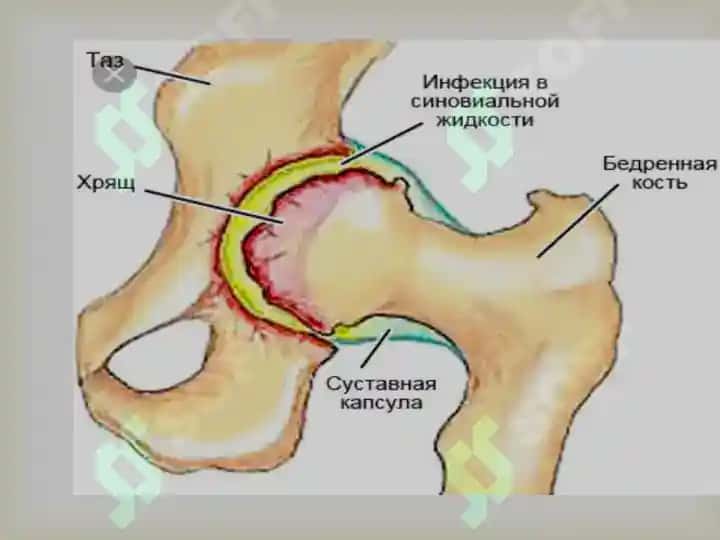 Yiringli artrit, osteomelit va suyak bo’g’im sili 3