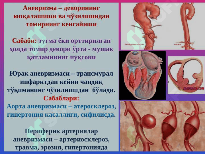 Qon tomirlar patologiyasi.Tomir anomaliyalari.Gipertenziya.Ateroskleroz.Anevrizmalar.YUIK 5