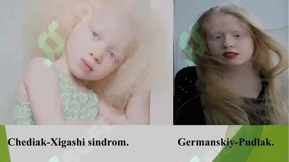 Albinizm Kasalligi 7