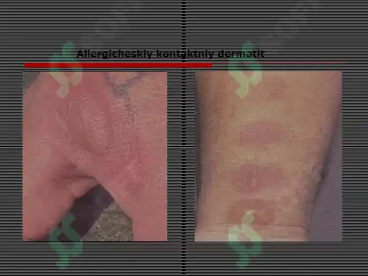 Allergodermatozlar Terining kasalliklari haqida tushuncha 3