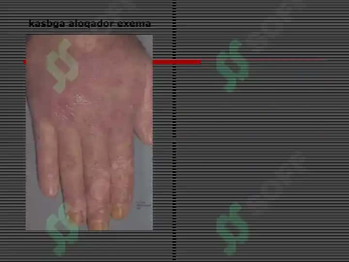 Allergodermatozlar Terining kasalliklari haqida tushuncha 4