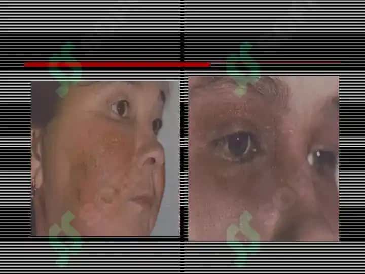 Allergodermatozlar Terining kasalliklari haqida tushuncha 6
