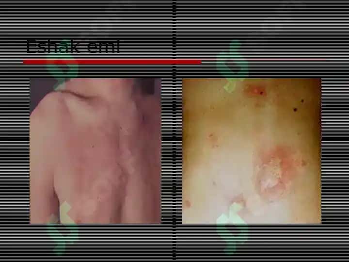 Allergodermatozlar Terining kasalliklari haqida tushuncha 7