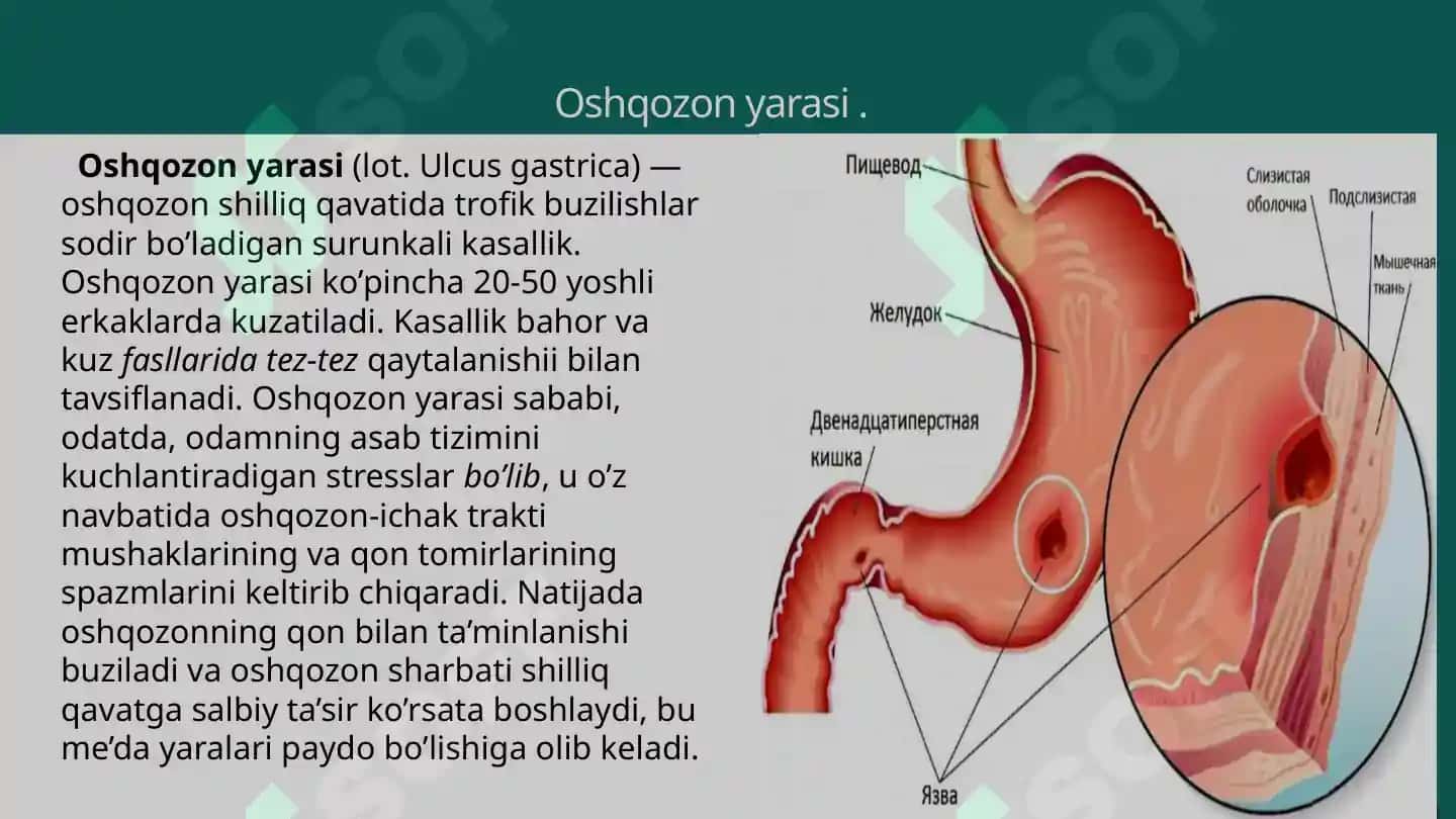 Oshqozonyarasi 3