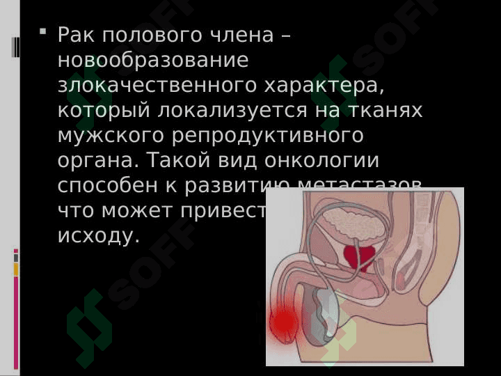ОПУХОЛИ МУЖСКИХ ПОЛОВЫХ ОРГАНОВ 5