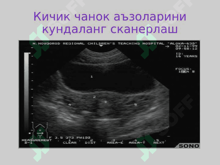 Репродуктив аъзоларнинг  ультратовуш ташхисоти 7