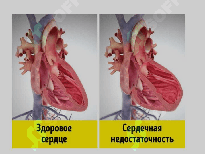 YURAK YETISHMOVCHILIGI 3