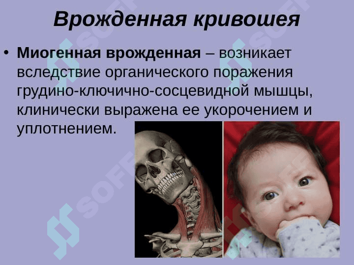 Врожденная мышечная кривошея. Косолапость 4