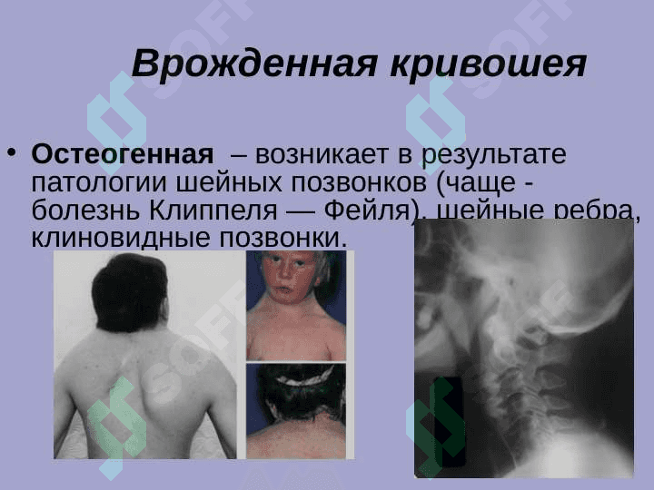 Врожденная мышечная кривошея. Косолапость 5