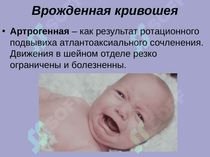Врожденная мышечная кривошея. Косолапость 7