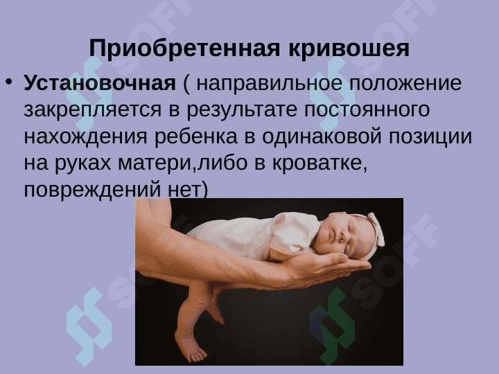 Врожденная мышечная кривошея. Косолапость 8