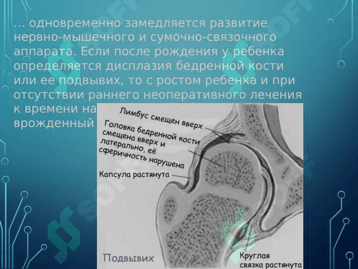 Врожденный вывих бедренной кости 5