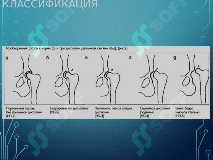 Врожденный вывих бедренной кости 8