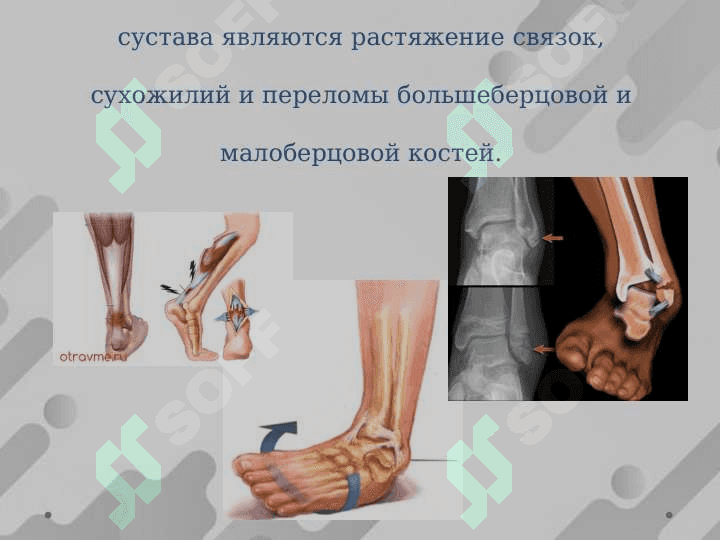 ПОВРЕЖДЕНИЕ ГОЛЕНОСТОПНОГО СУСТАВА 2