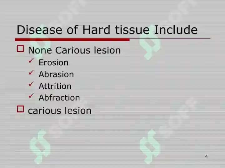 DISEASE OF HARD TISSUE OF TOOTH,PULPITIS AND PERIAPICAL LESIONS 4
