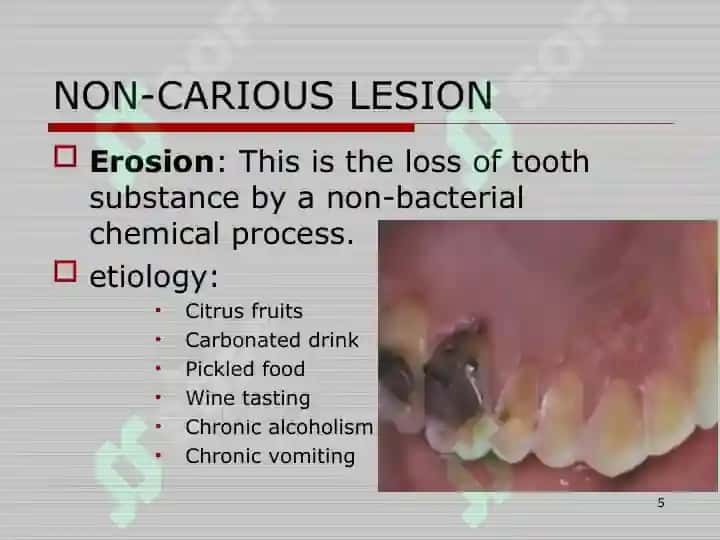 DISEASE OF HARD TISSUE OF TOOTH,PULPITIS AND PERIAPICAL LESIONS 5