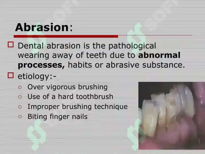 DISEASE OF HARD TISSUE OF TOOTH,PULPITIS AND PERIAPICAL LESIONS 6