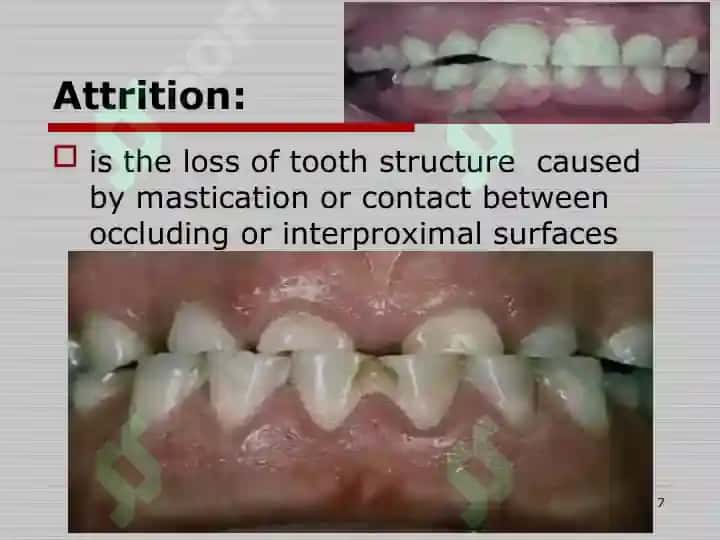DISEASE OF HARD TISSUE OF TOOTH,PULPITIS AND PERIAPICAL LESIONS 7