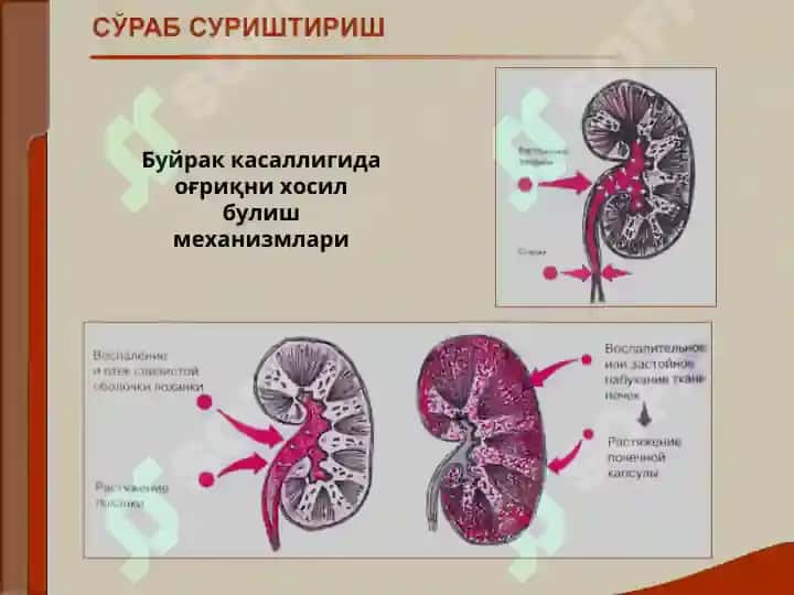 Buyrak kasalligi bilan o'rgangan bemorlarini tekshirish. Asosiy klinik sindromlar. Bujrak etishmovchiligi 5