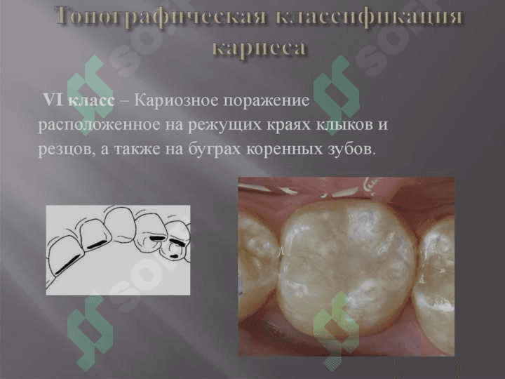 6-sinf karies kovakni charxlashning o'ziga xos tomonlari. 4
