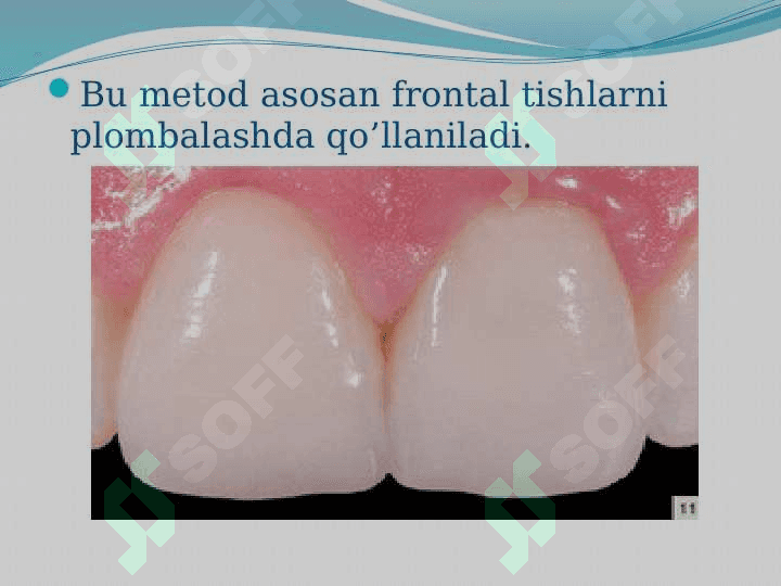 Plombalashning "Sendvich" usullari 6
