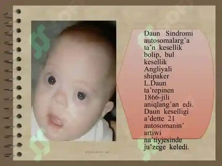Daun sindromi 2