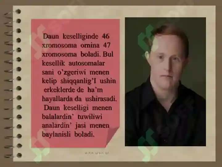 Daun sindromi 3
