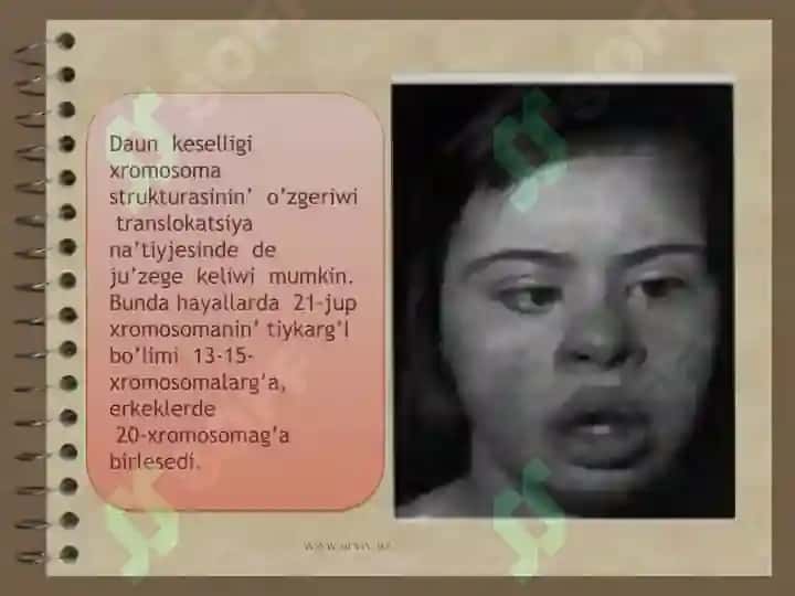 Daun sindromi 4