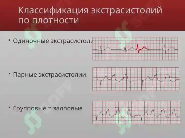 Экстрасистолии 5