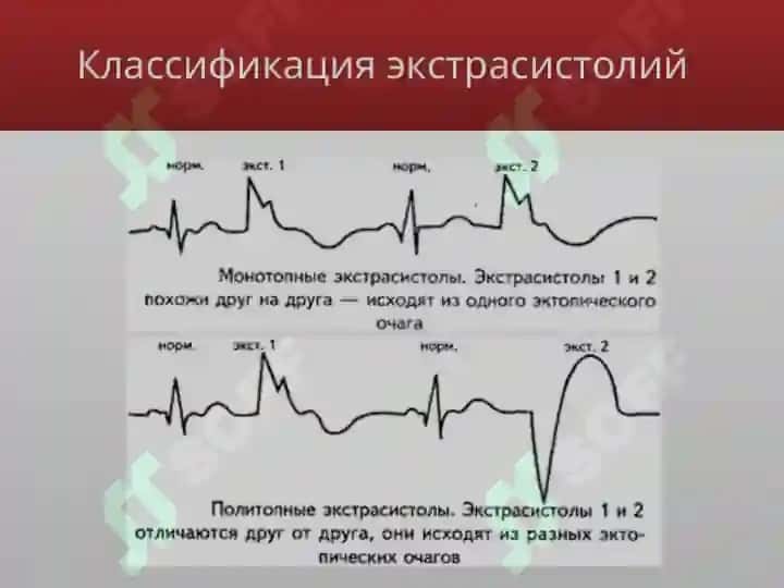 Экстрасистолии 6