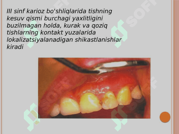III sinf karioz bo'shliqlarini charxlash va plombalash. 2