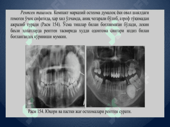 Mavzu: Xavfsiz osteogen o'smalari. Klinikasi, tashxisi,davolash (osteoma, osteoid-osteoma, osteoblastoma, xondroma, osteoxondroma, gigant xujayrali o'sma). 5