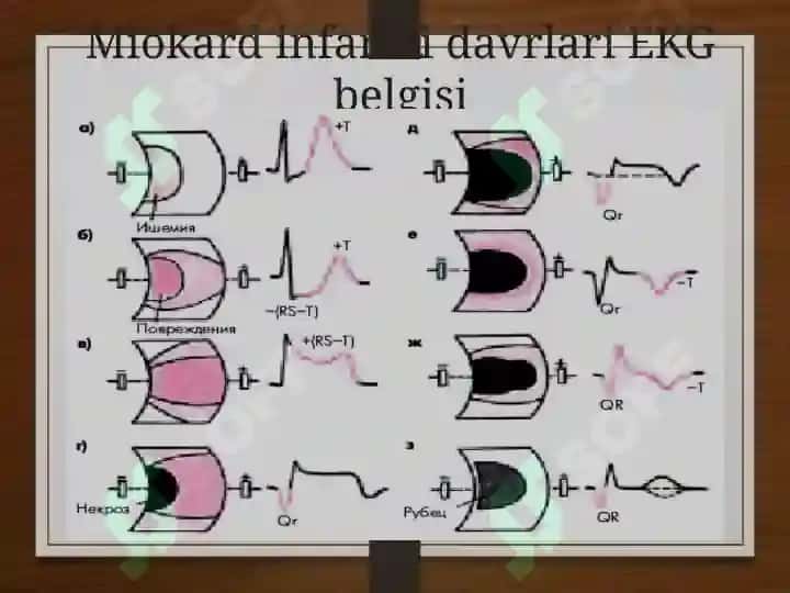 MIOKARD INFARKTI 7