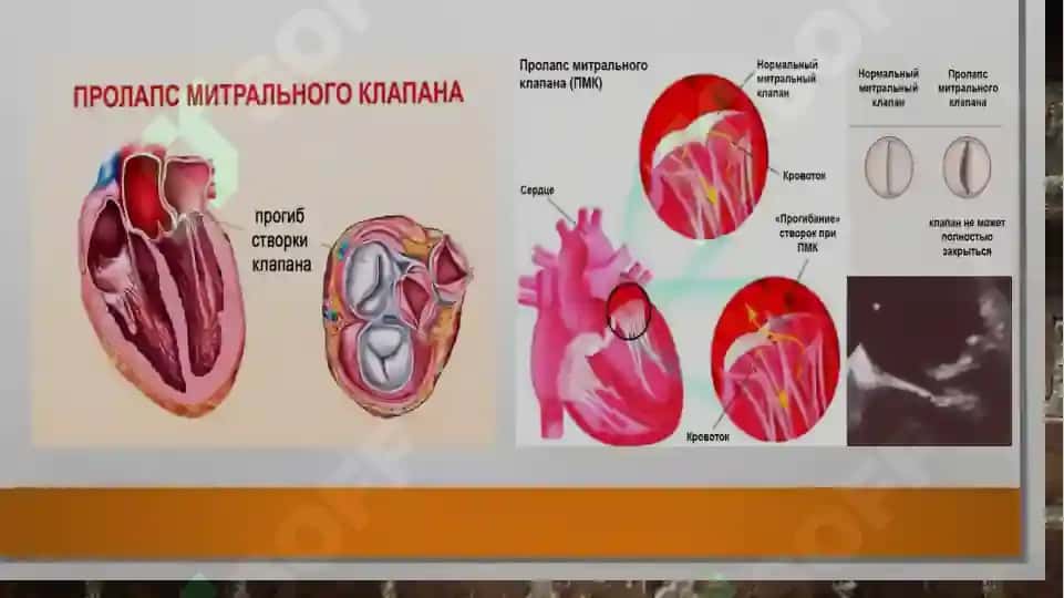 Mitral klapan prolapsi 4