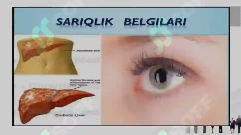 Sariqlik kasaligi 4