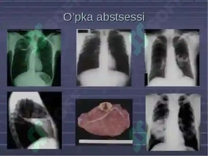 O’pkaning   yiringli kasalliklari.  O’pka abssesi va      gangrenasi 4