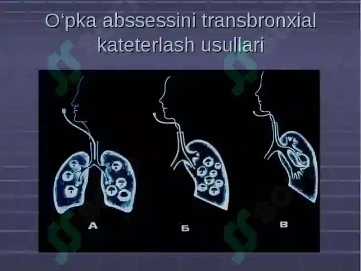 O’pkaning   yiringli kasalliklari.  O’pka abssesi va      gangrenasi 6