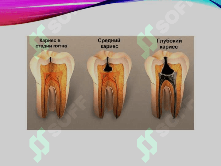 Chuqur karies.Klinikasi, qiyosiy      tashxisi, davolash rejalari 3