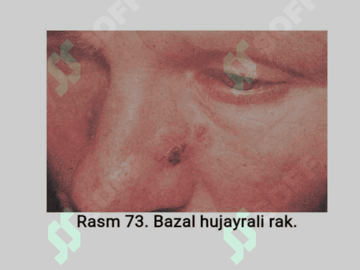 Terining xavfli o'smalari: Bazalioma,  yassi
           hujayrali rak va melanoma 4