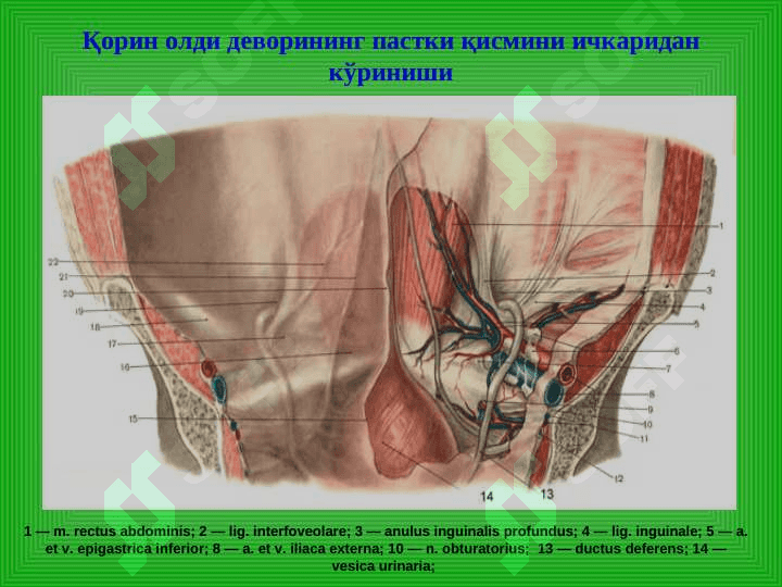 Чов, сон, киндик ва қорин оқ чизиғи чурралари 3