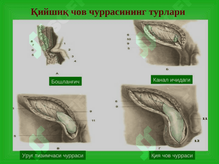 Чов, сон, киндик ва қорин оқ чизиғи чурралари 6