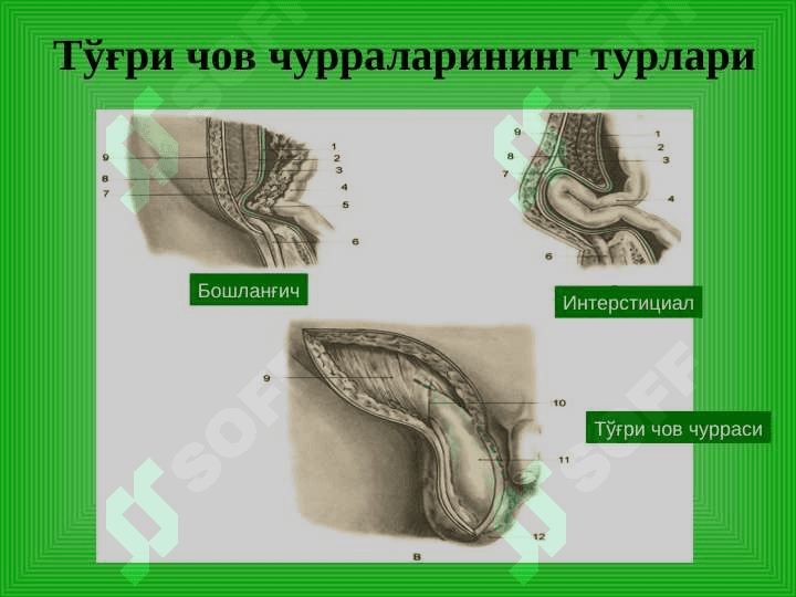 Чов, сон, киндик ва қорин оқ чизиғи чурралари 7