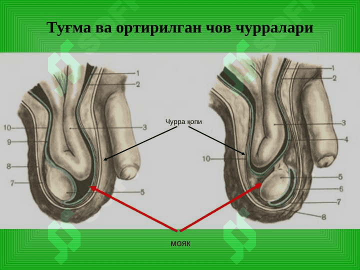Чов, сон, киндик ва қорин оқ чизиғи чурралари 8
