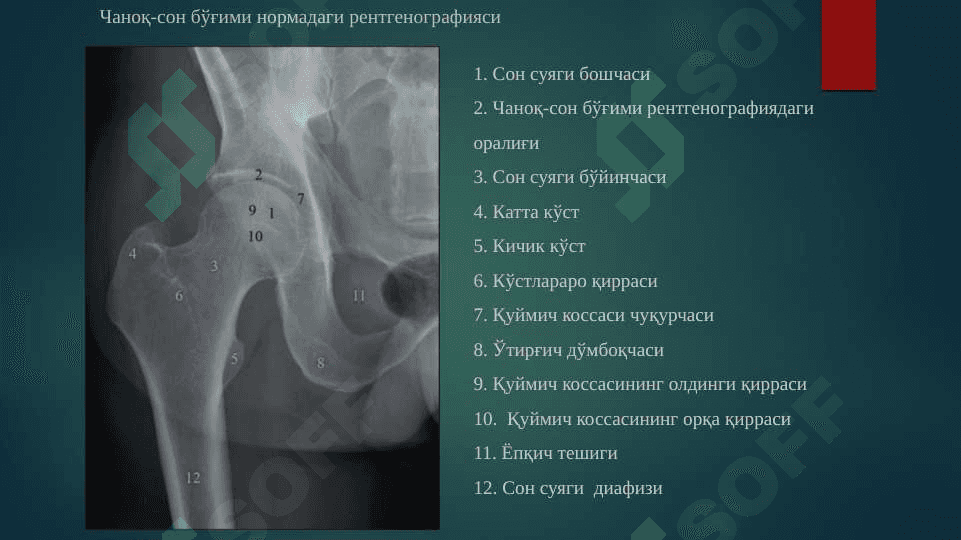 Oyoq suyaklari sinishlari ppt 3