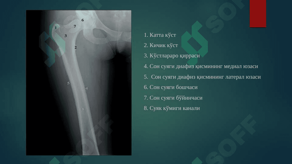 Oyoq suyaklari sinishlari ppt 4