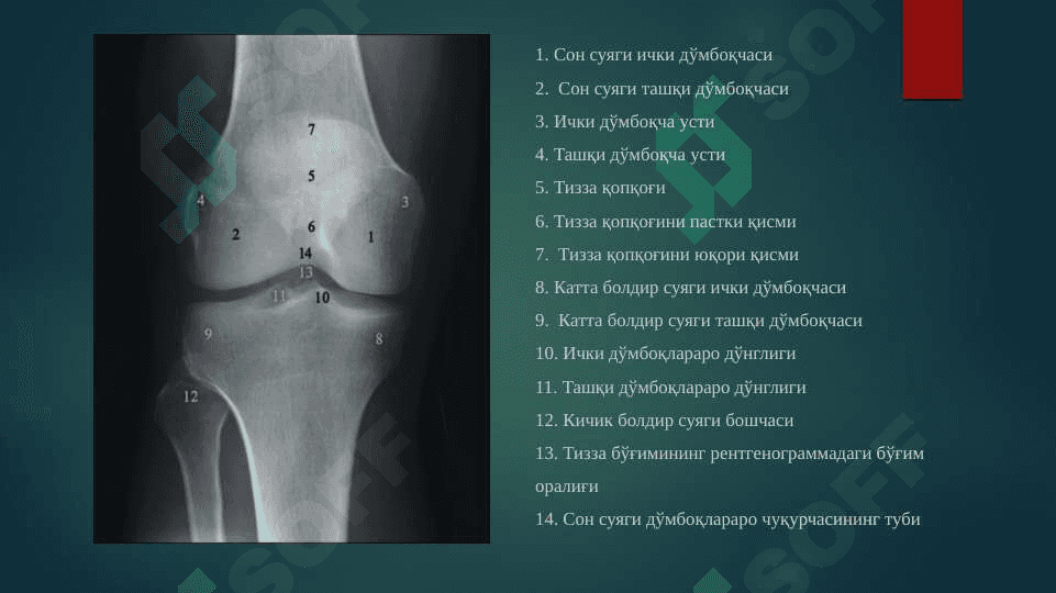 Oyoq suyaklari sinishlari ppt 5