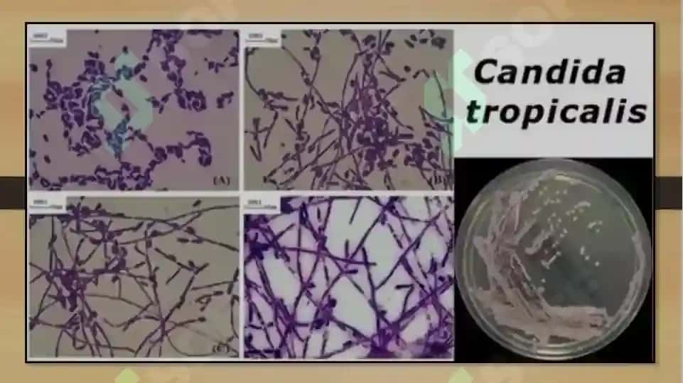 Candida spp. Va invaziv mikozlar: tashxislash va davolash 4